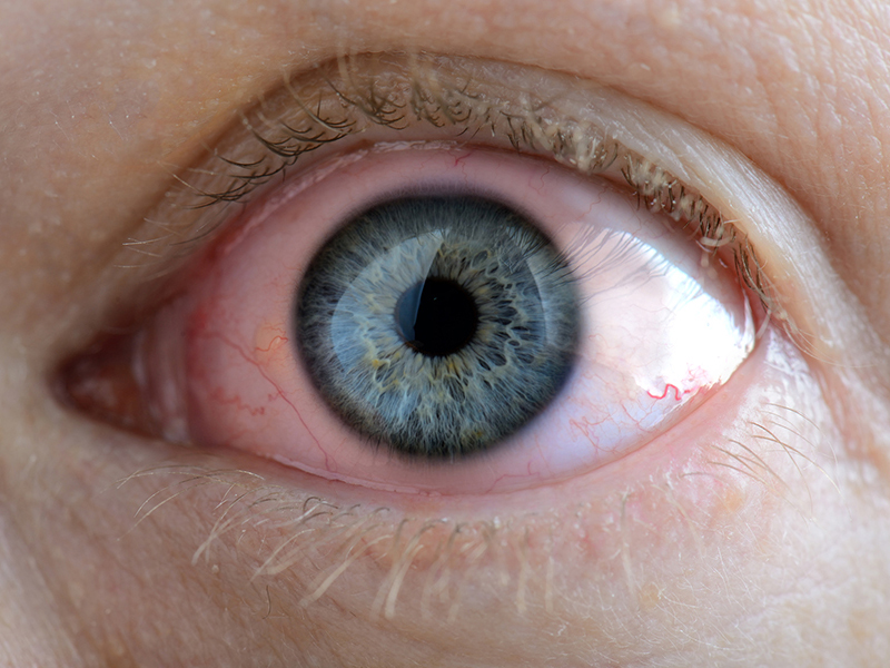 Irritierte Augen können mit Heparin Augensalbe oder Heparin Augentropfen behandelt werden.
